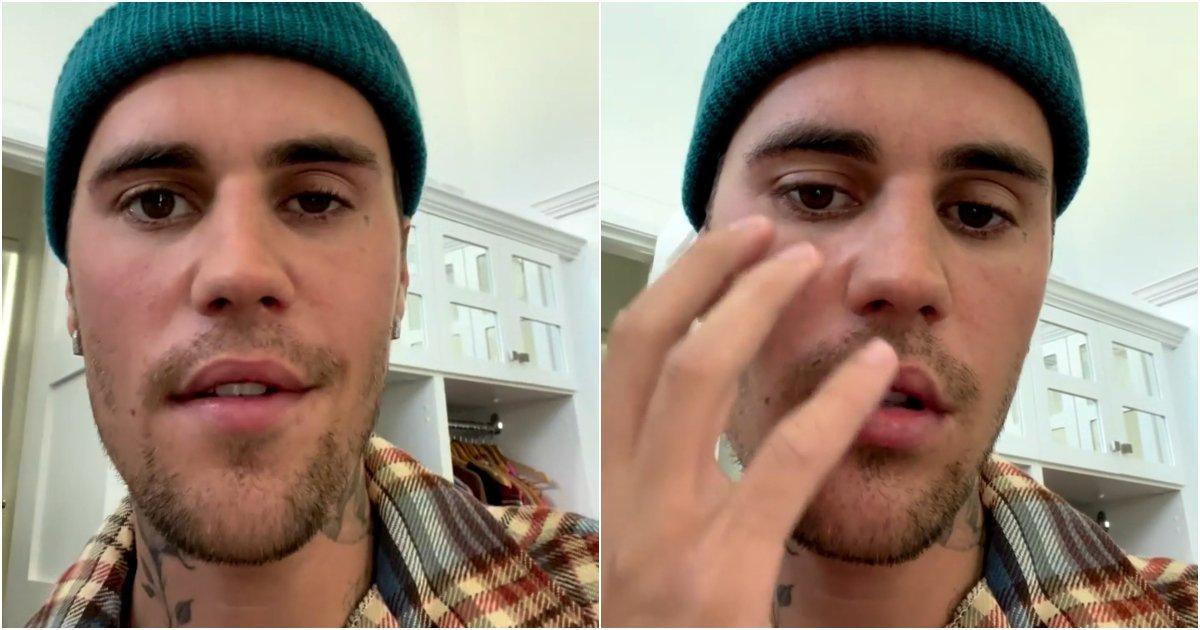 Justin Bieber Says Half Of His Face Is Paralysed, Reveals He Has Ramsay Hunt syndrome